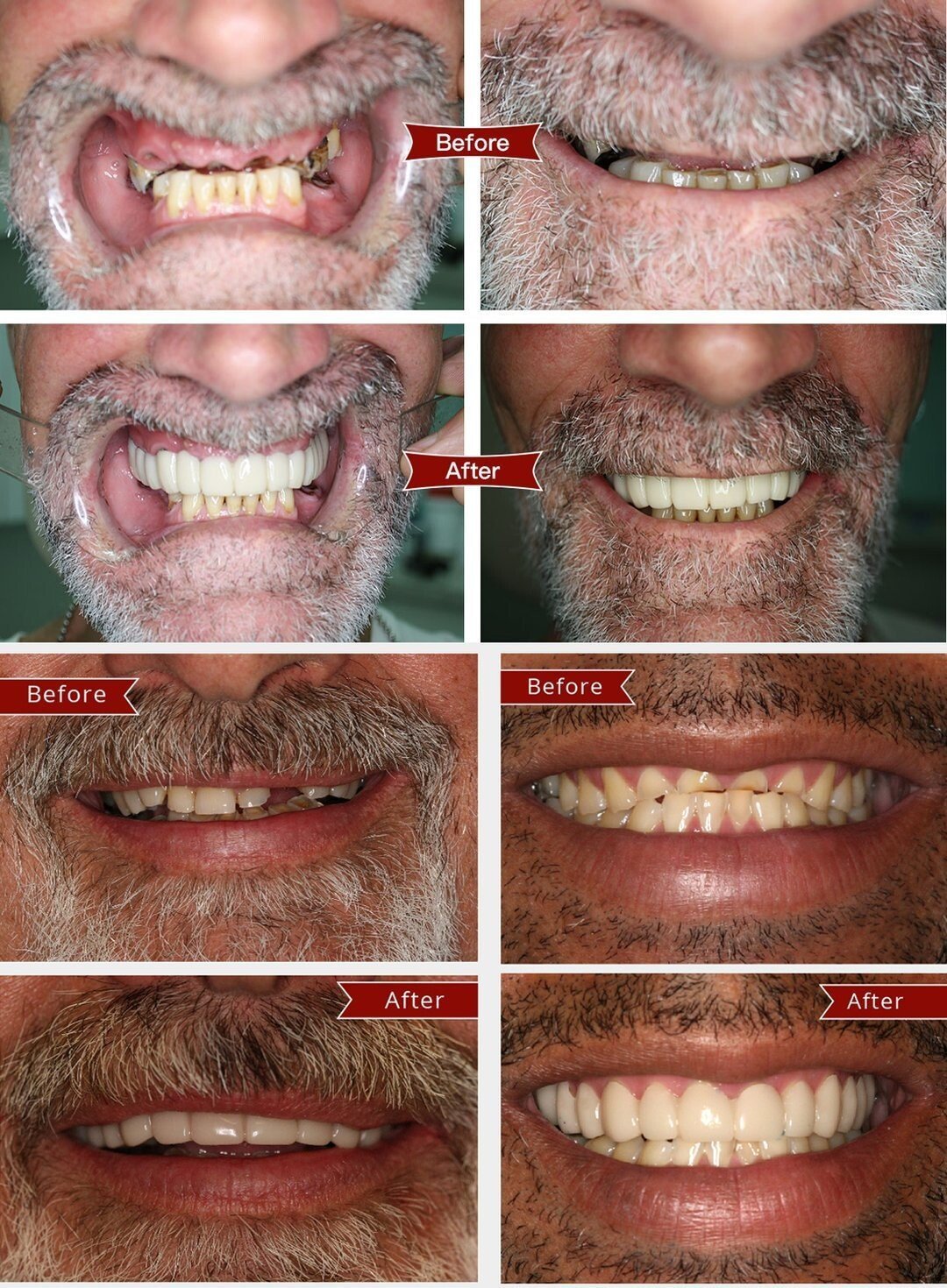 Adjustable Snap-On Dentures