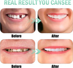 Teeth veneers Instant Cosmetic Veneers (Upper & Lower) A Listveneers