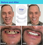 Teeth veneers Instant Cosmetic Veneers (Upper & Lower) A Listveneers