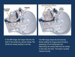 Apnea Tongue Stabilizing Device Aleck